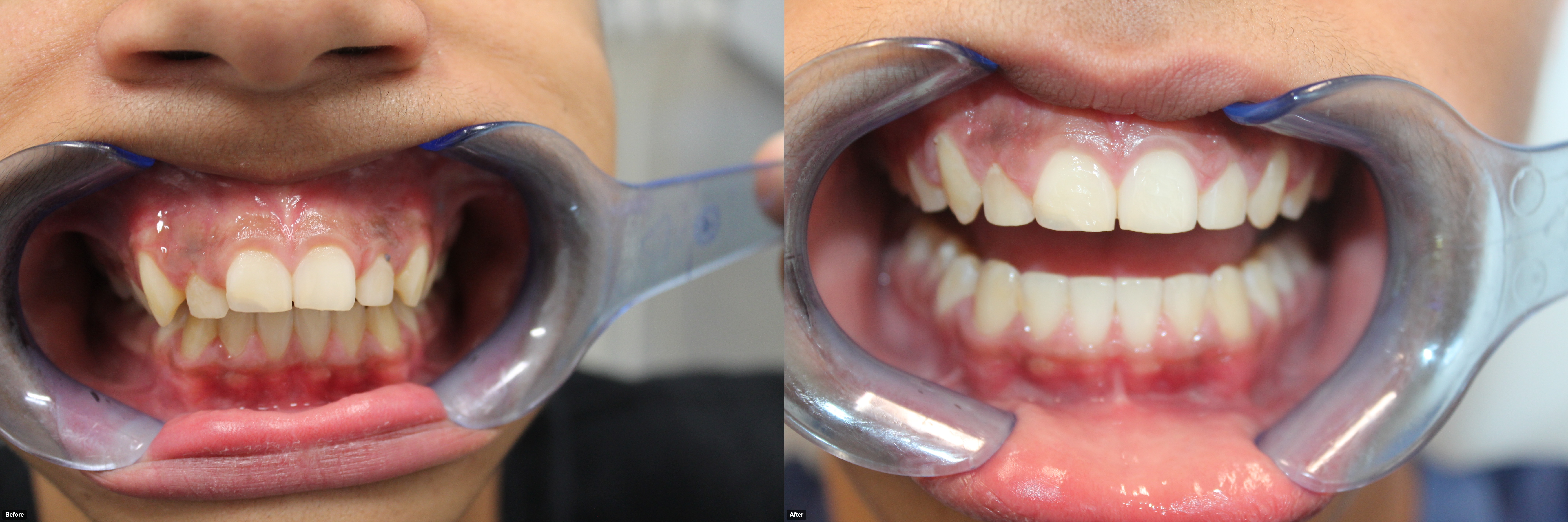 C.Clark-before-after