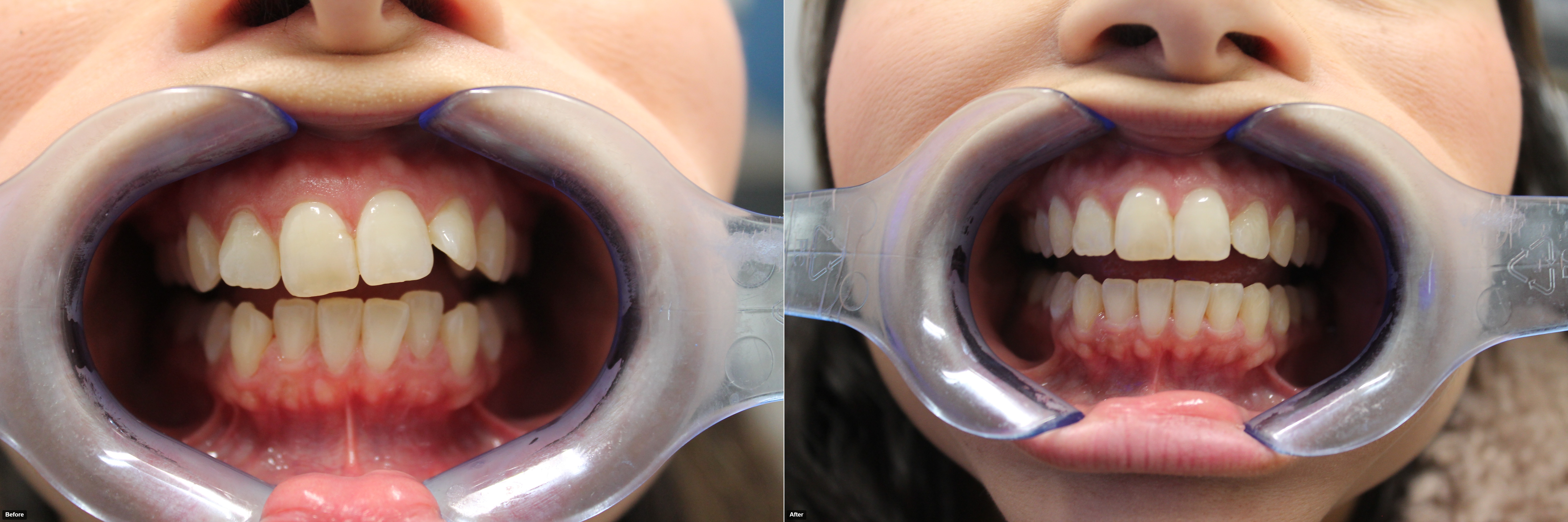 C.Vazquez-before-after