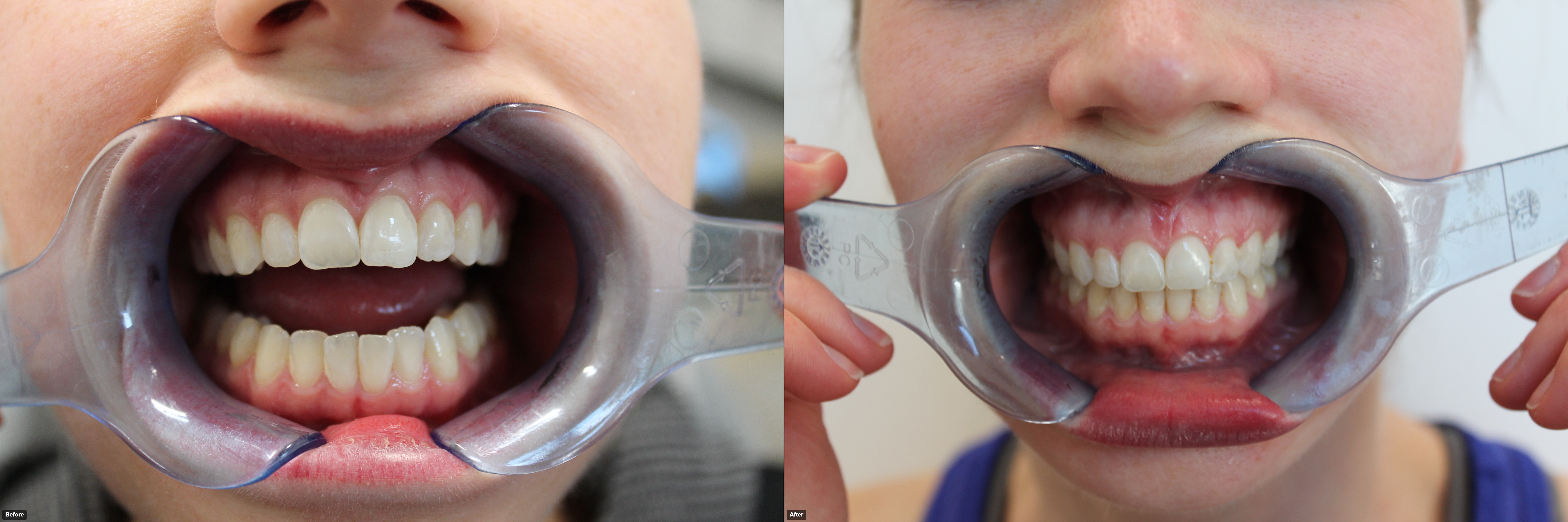 K. Nofzinger-before and after