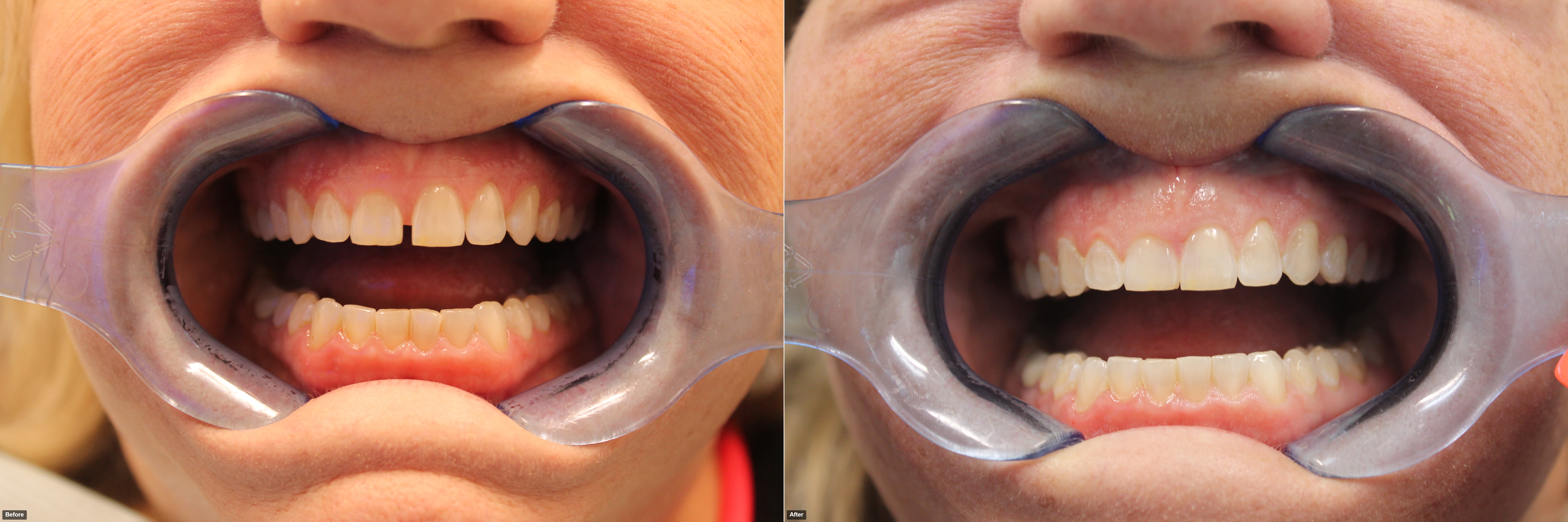 M.Killian-before-after