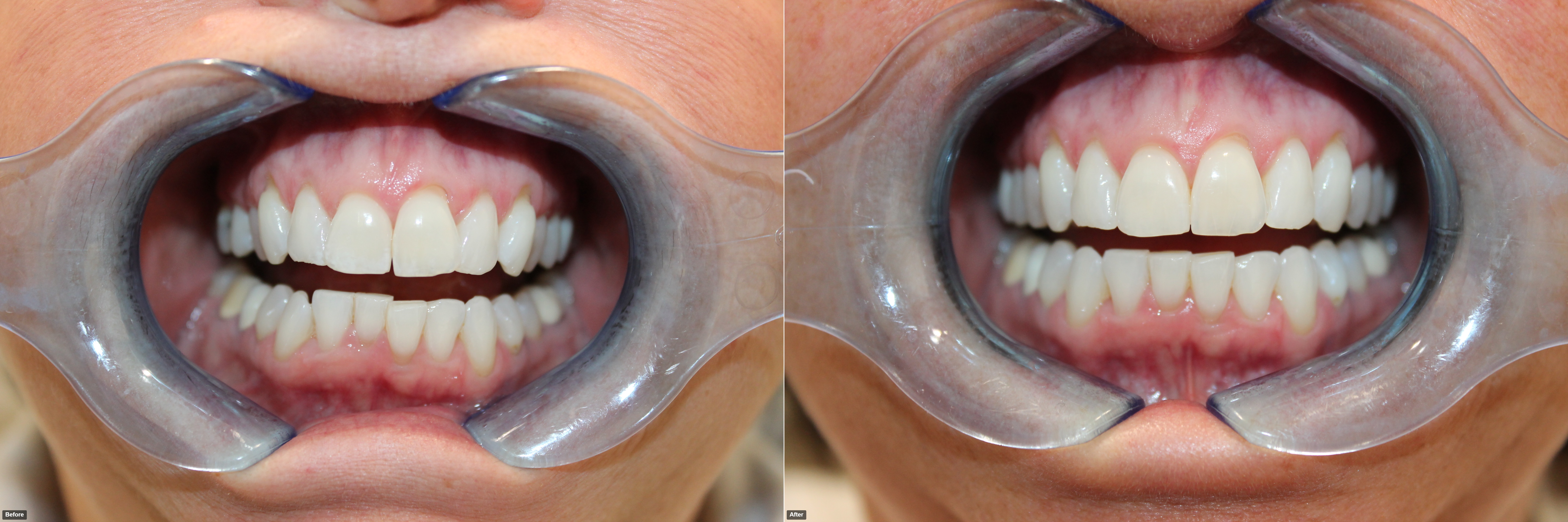 M.Makarewicz-before and after